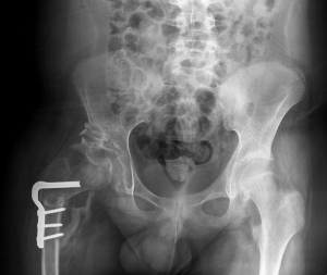 DDH Congenital Hip Dysplasia Post Op x-Ray