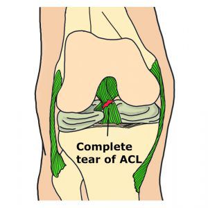 ACL injury Complete Tear Anterior Cruciate Ligament Image