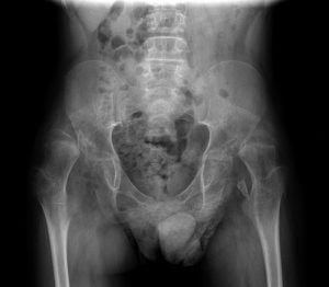 Cerebral Palsy Hip Dislocation x-Ray