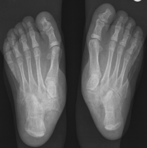 Flat Feet x-Ray Left Right