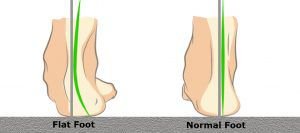 Flat foot vs Normal foot mage
