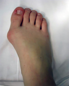 Hallux Valgus Bunion Child Picture