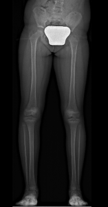 Leg Lenght Discrepancy Pre-Op x-Ray