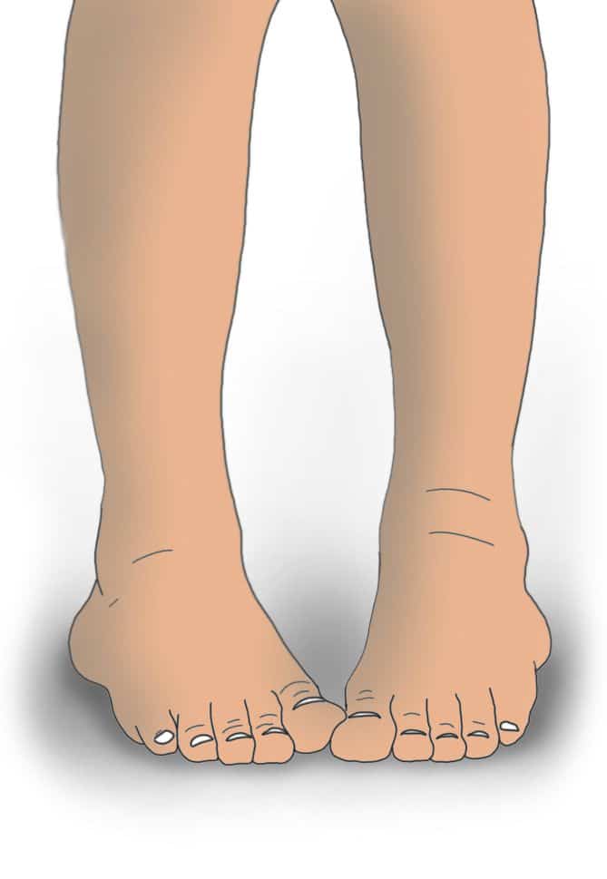 Fix Pigeon Toe Prof. Nicola Portinaro Orthopedic Suregon