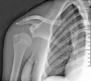 Shoulder Dislocation X-Ray