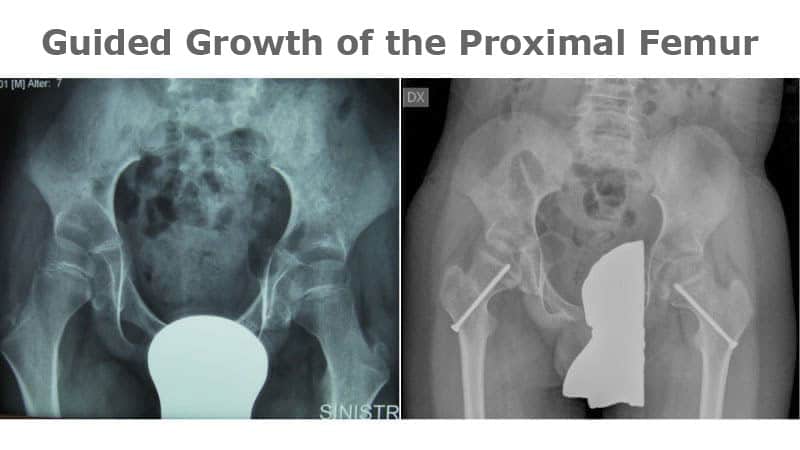 Guided Growth Proximal Femur