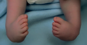 The front half of an affected foot turns inward and the heel. Newborn Club Foot Causes - Congenital Clubfoot Prof Nicola Portinaro Orthopedic Suregon