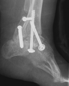 Spina Bifida Post Op Clubfoot surgery X-Ray