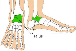 Congenital Vertical Talus Image