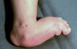 Congenital Vertical Talus Picture