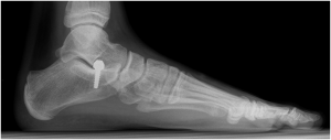 Flat Foot Post-op X-ray Prof Portinaro Orthopedic Surgeon