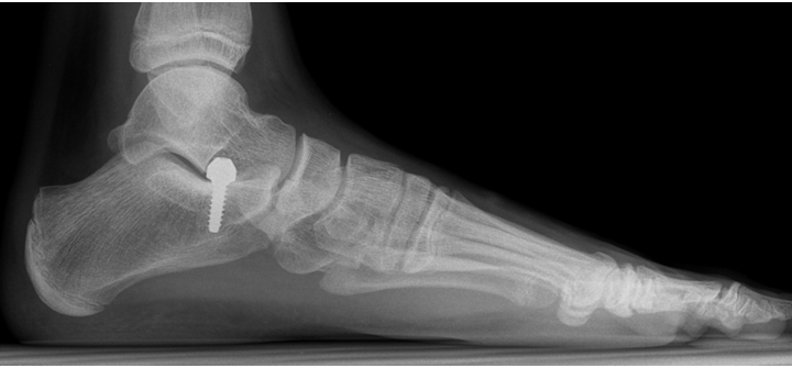 Flat Feet surgery Post-op X-ray Prof Portinaro Orthopedic Surgeon