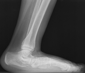 Flat Foot x-Ray left