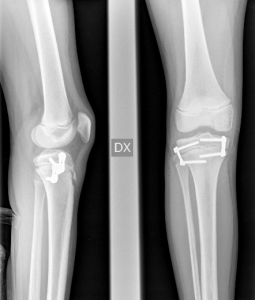 Dettaglio Radiografia Dismetria arti inferiori Post-Op Prof. Portinaro Chirurgo Ortopedico