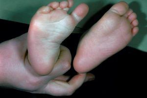 Metatarso Varo o Metatarso adotto immagine piedi bambino