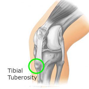 Osgood Schlatter Disease Tibial Tuberosity Image