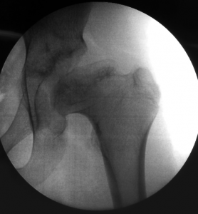 Perthe Disase Pre Op x-Ray Prof. Nicola Portinaro Orthopedic Surgeon
