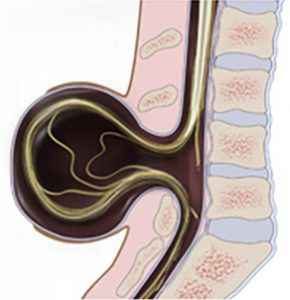 Spina Bifida Myelomeningocele