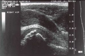 Transient Synovitis Hip Ultrasound