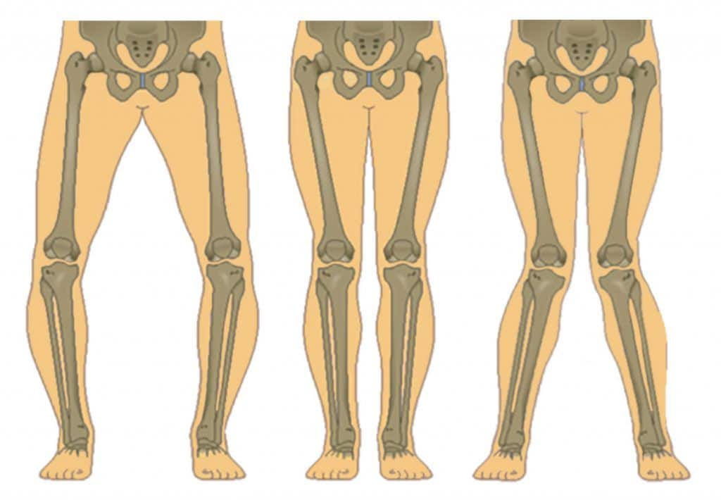 bow legs vs normal vs knock knees Image