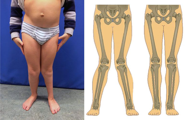 Many parents wonder how to fix knock knees or bow legs