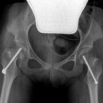 hip x ray 6 years later TMH-PF Prof. Nicola Portinaro