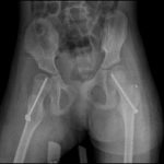 hip x ray post op TMH-PF Prof Nicola Portinaro