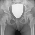 hip x ray pre op Prof Nicola Portinaro