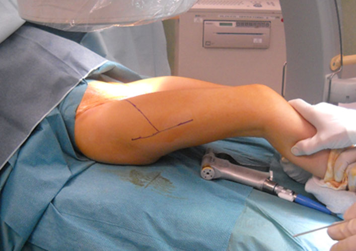 How to Prevent Developmental Dysplasia of the Hip in Cerebral Palsy