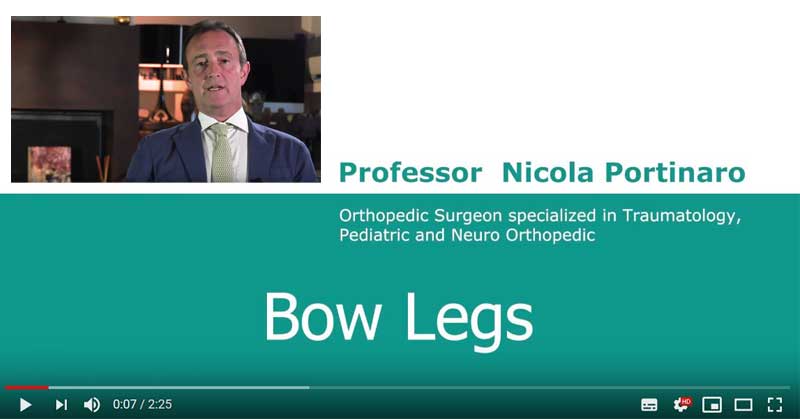 ginocchio varo video youtube prof nicola portinaro