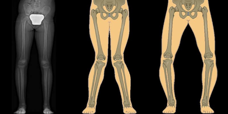 Temporary Epiphysiodesis