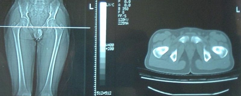 paralisi-cerebrali-chirurgia-precoce-rx-bacino