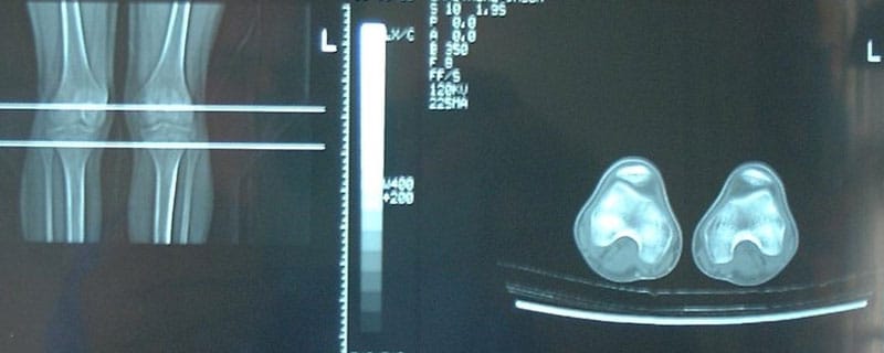 paralisi-cerebrali-chirurgia-precoce-rx-ginocchia