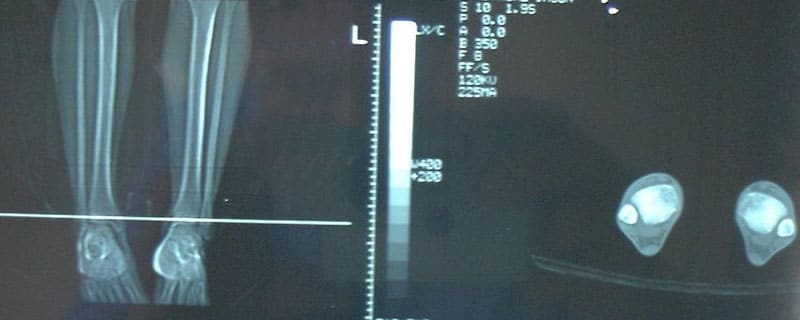 paralisi-cerebrali-chirurgia-precoce-rx-piedi