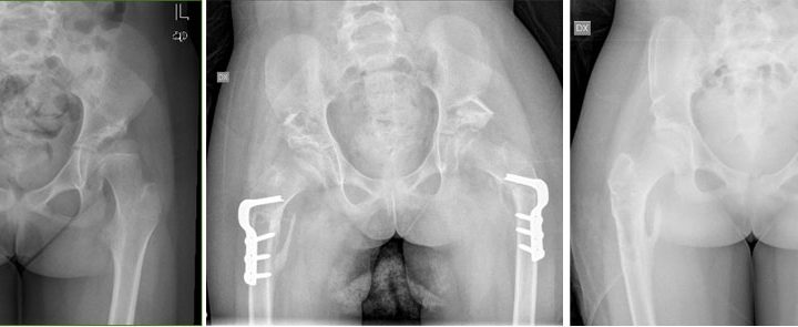 Pelvic and femoral osteotomy