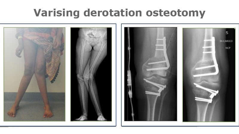 Varising derotation osteotomy