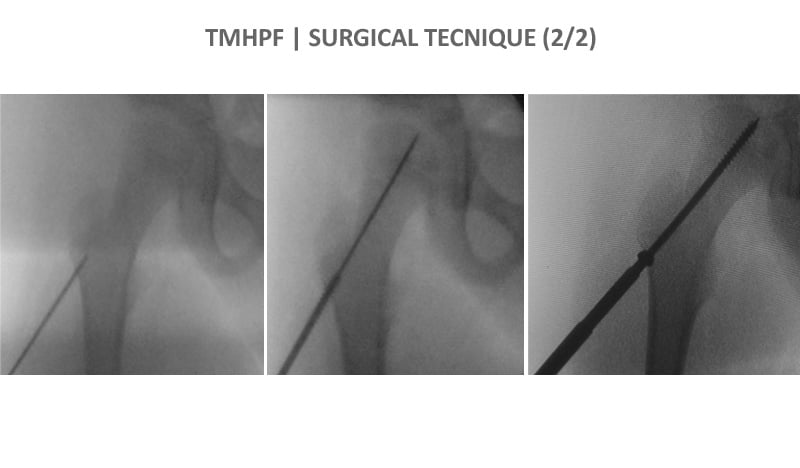temporary medial hemiepiphysiodesis proximal femur portinaro nicola post surgical tecnique
