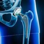 Anterior Hip Replacement: