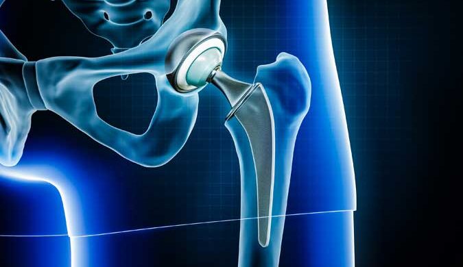 Anterior Hip Replacement: