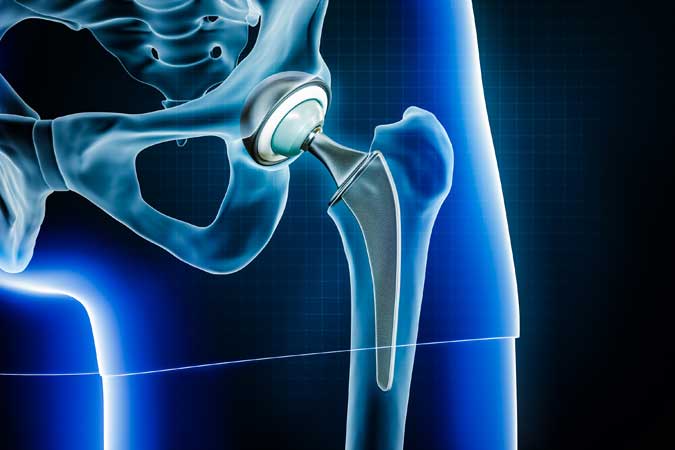 Anterior Hip Replacement: